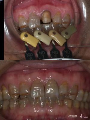 Transluzente Zirkonia-Kronen Mehrschicht-Gradient-Technologie für optimale Transluzenz und langfristige Biokompatibilität