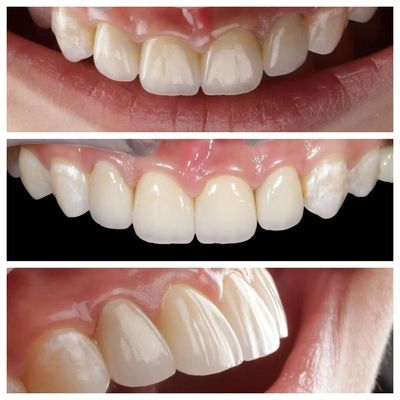 Anterior Zahn Anzeige Zahnfolie mit 0,5 mm Dicke und perfekte Durchlässigkeit