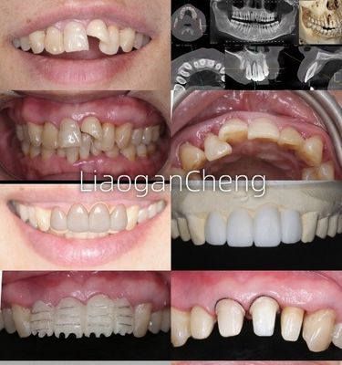 Biokompatibilität Sichere Zirkonia-Zahnkranzen für langfristige und implantatgestützte Restaurierungen