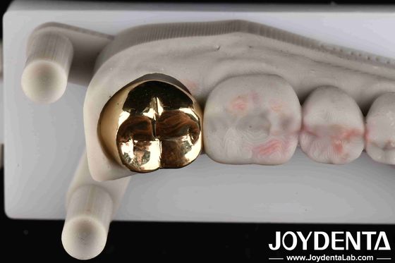Professionelle Goldkrone für Zahn-Oral-Klinische Anwendung