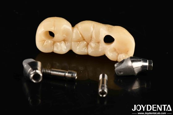Implantat Krone und Brücke mit anpassbarem Design hohe Haltbarkeit genaue Passform