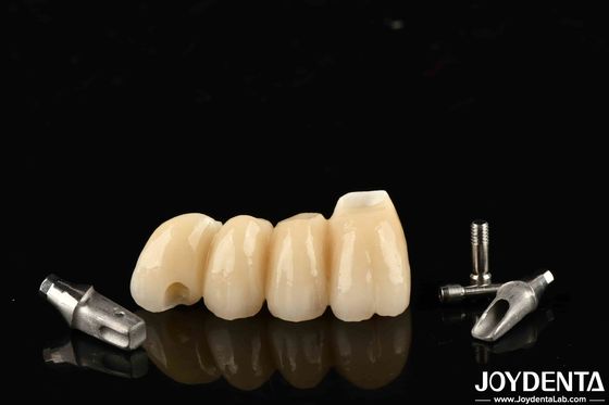 Anpassbare Implantatkrone und -brücke aus Porzellan für eine perfekte Funktion