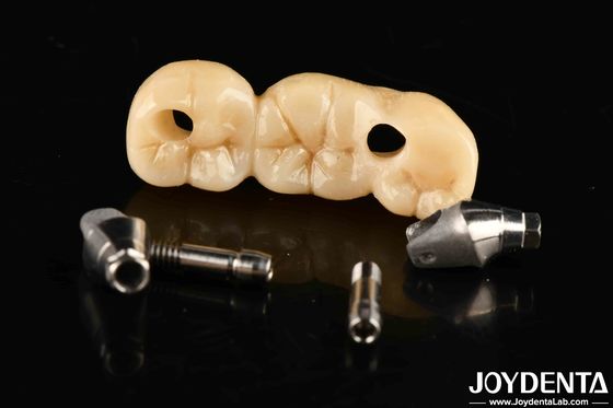 Starke Implantate Krone und Brücke Perfekte Lösung für ästhetisch ansprechende Ästhetik
