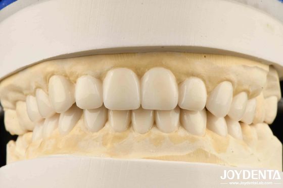 Ästhetische, biomimetische Diagnostik-Wax-Up für Veneers