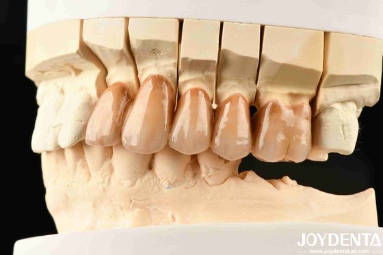 Bionische Zähne Schichtzirkonie mit Bionischen Blattmikrogravur und mehrfarbiger biomimetischer Lamination für eine fortschrittliche Lichtsimulation