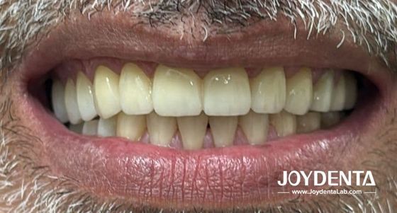 Zirkonie-Zahnprothesen, die natürliche Zähne imitieren