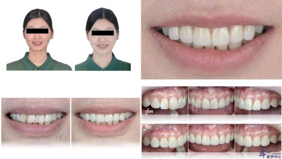 Die beliebtesten Produkte von Joydentalab: Simulierte ästhetische Veneers