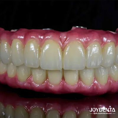 Leichtgewichtige Zahn Titanium Malong Hybridbrücke Komfortabel für Zahnrestaurierung