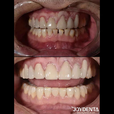 Natürliche Form Kosmetik Zahnmedizin Porzellan Veneers, Zahnmedizin Kosmetik Porzellan Veneers