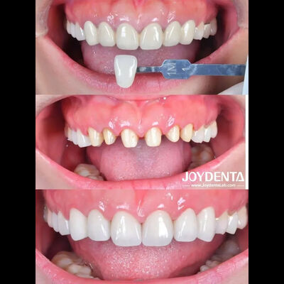 Zirkonia Zahnkrone Fallstudie ∙ Global Lab Outsourcing - Joydentalab