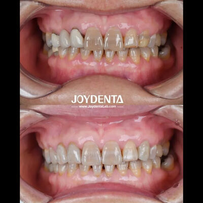 Leichtgewichtige Zahnzirkonien für eine optimale Patientenerfahrung Natürliche Farbe