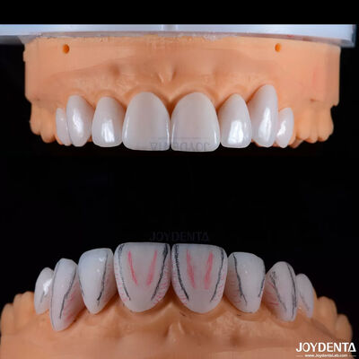 Maßgeschneiderte Dental Emax Keramik Veneers mit Schmutzfestigkeit