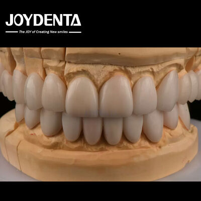 0.3 mm Dicke Ips Emax Veneers Keramik Veneers Vorder- und Hinterseiten Restaurierungen